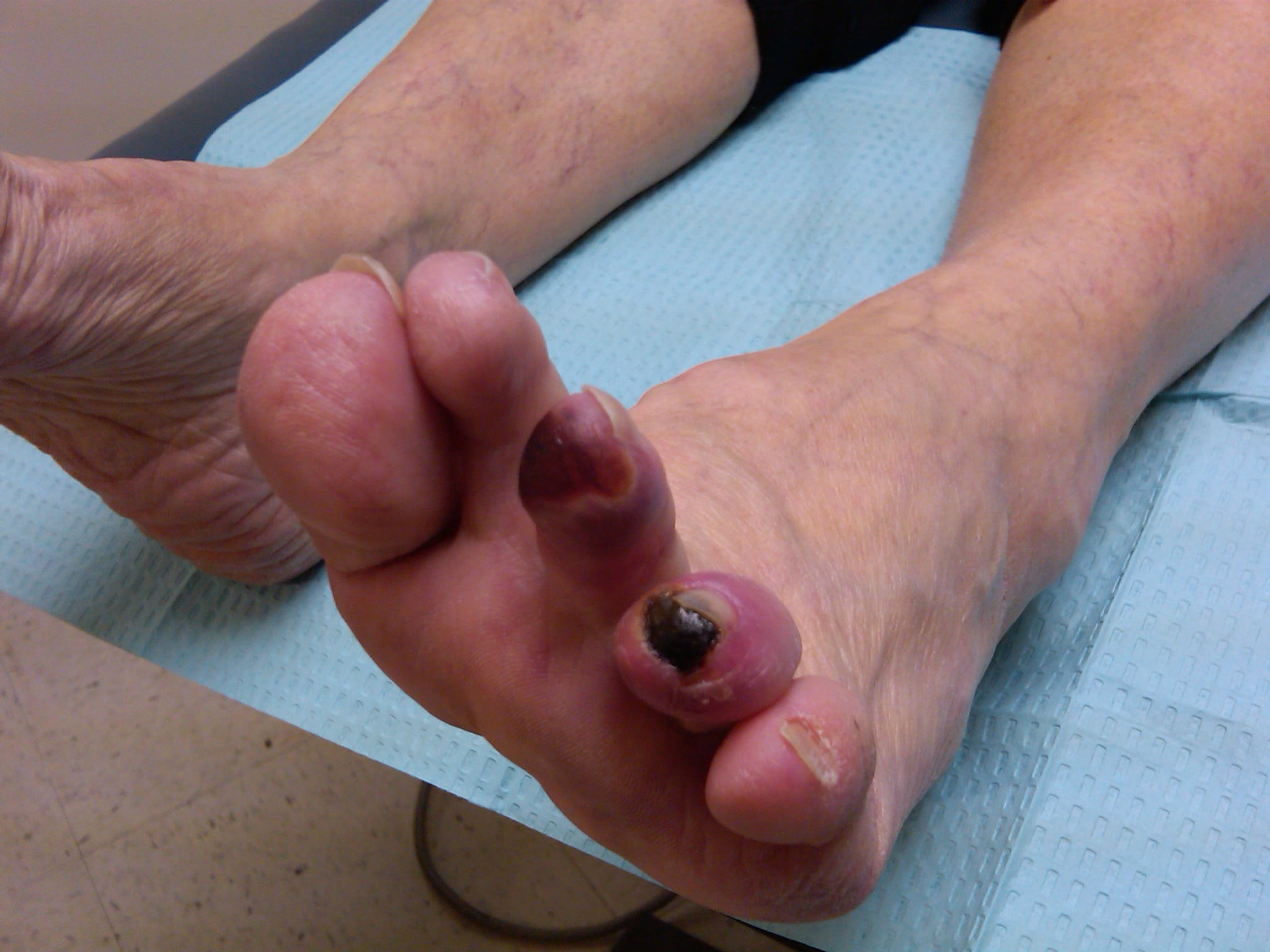 Gangrena diabetică