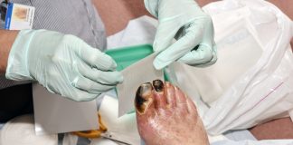 Informații utile despre gangrena diabetică – complicațiile arteriopatiei