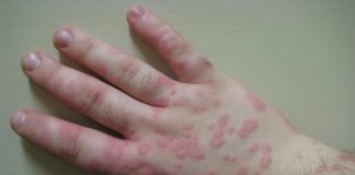 Nutrienți eficienți pentru tratarea intoxicației cu arsenic. Află care sunt sursele de arsenic și ce simptome apar