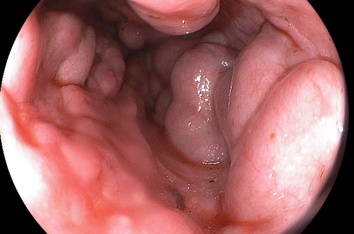 tratamentul varicelor esofagiene)