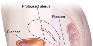 Prolaps uterin sau hernie a planșeului pelvin – Ce simptome produce această afecțiune și cum se tratează
