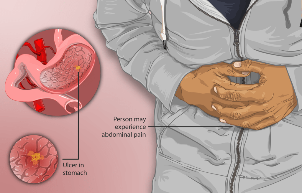 ulcer peptic