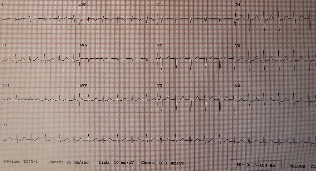 tahicardia ventriculară