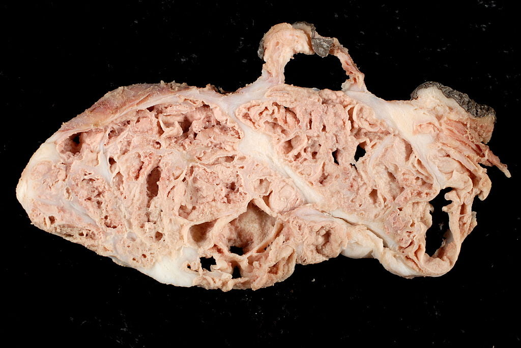 Insuficiență renală