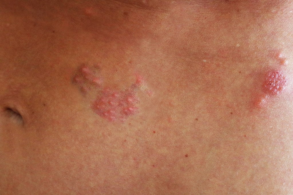 eruptii cutanate