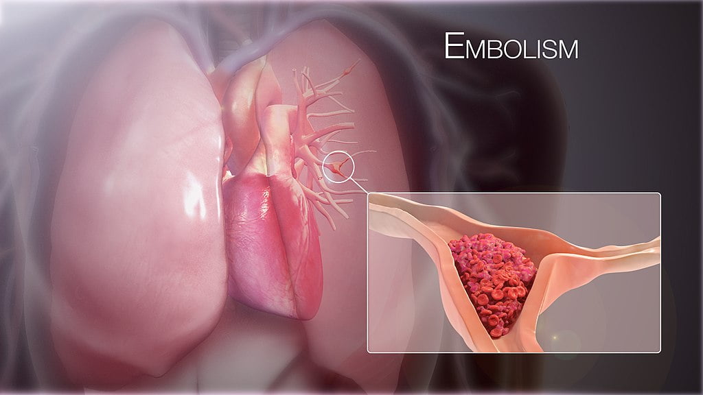 Embolia pulmonară