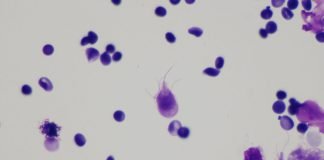 Lambliaza, boală parazitară - În ce constă infecția cu giardia intestinalis