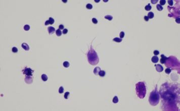 Lambliaza, boală parazitară – În ce constă infecția cu giardia intestinalis? Lambliaza, boală parazitară - În ce constă infecția cu giardia intestinalis
