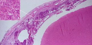 Meningita meningococică – infecție transmisibilă periculoasă, produsă de Neisseria meningitidis