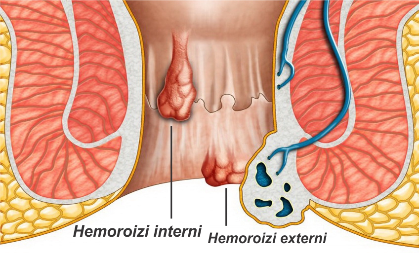 hemoroizi-1