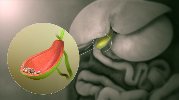 8 simptome care anunță afecțiunile colecistului – Când este necesar să te operezi 8 simptome care anunță afecțiunile colecistului – Când este necesar să te operezi