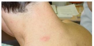 Boala Fabry perturbă stocarea lipidelor – Care sunt metodele de tratament pentru eliminarea simptomelor