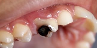 Caria dentară, cangrena și abcesul – prevenire și tratament Caria dentară, cangrena și abcesul – prevenire și tratament