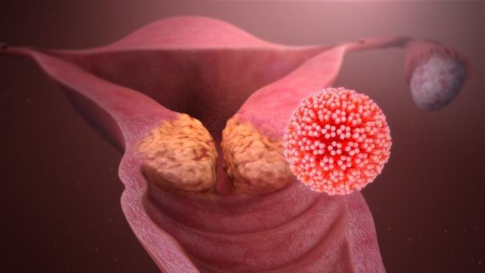 Mai mult de jumătate dintre bărbați sunt purtatori ai virusului HPV – Cum se transmite infecția cu HPV și care este riscul ei de cancer Mai mult de jumătate dintre bărbați sunt purtatori ai virusului HPV – Cum se transmite infecția cu HPV și care este riscul ei de cancer