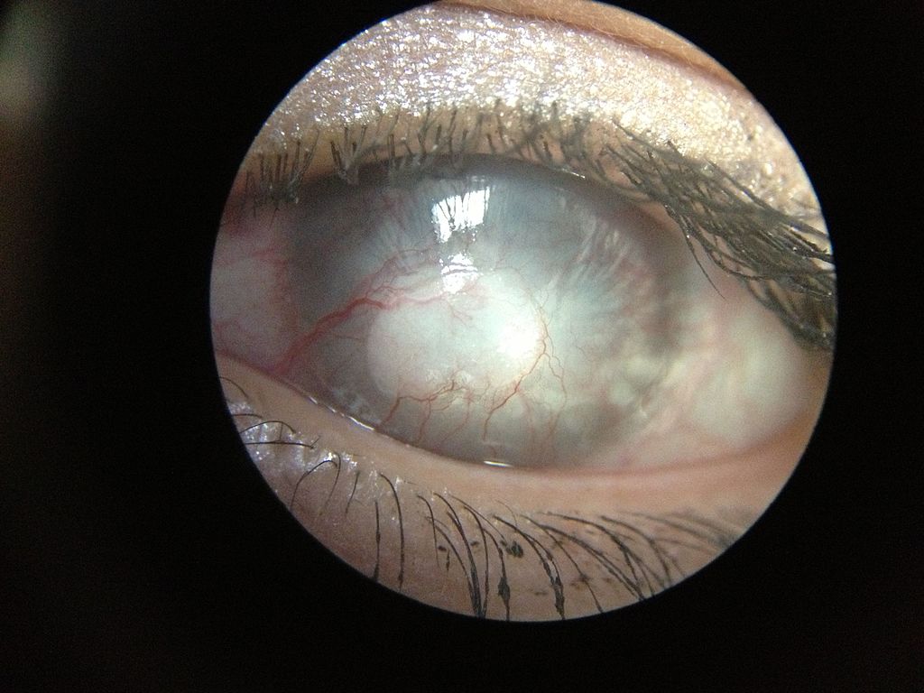ulcear corneal