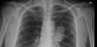 Cancerul pulmonar și hemoptizia sau tusea cu sânge – Iată tot ce trebuie să știi despre simptomele cancerului pulmonar
