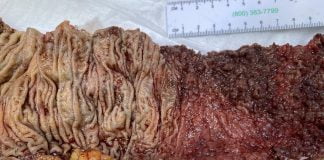 Suferi de colită ulcerativă Iată în ce constă tratamentul acestei boli cronice