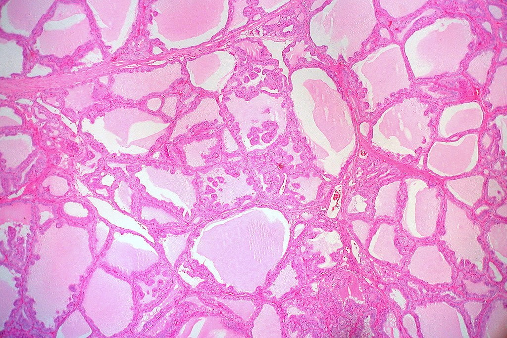 Hipertiroidismul