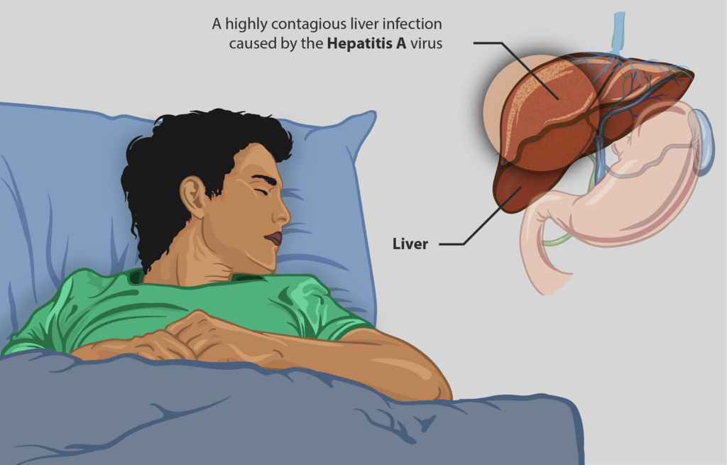 hepatita A