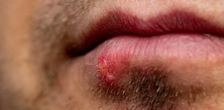 Sfaturi pentru tratamentul infecției cu HSV 1 la buze – Cel mai bun remediu pentru Herpes