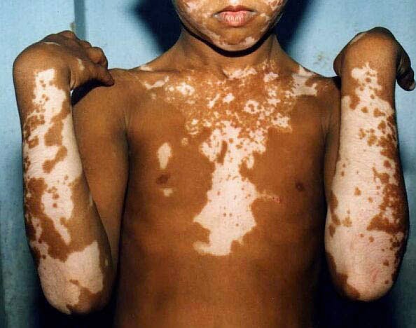 Vitiligo, pete albe pe brațe și corp, Foto: vitiligocureinfo.blogsp