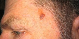 Metode eficiente care nu trebuie să-ți scape și care te vor ajuta să previi cancerul de piele