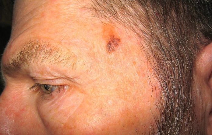 Metode eficiente care nu trebuie să-ți scape și care te vor ajuta să previi cancerul de piele Metode eficiente care nu trebuie să-ți scape și care te vor ajuta să previi cancerul de piele