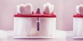 Velvet Dental Implant Dentar