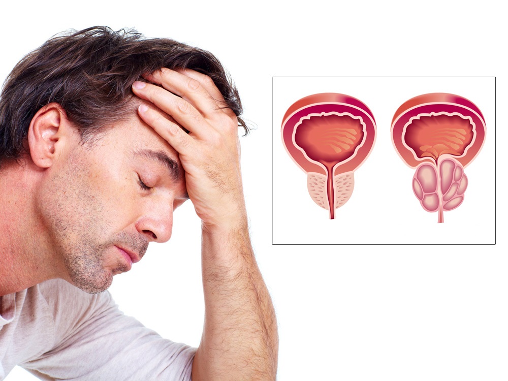 Durere de prostată și articulații Durere de șold scleroză multiplă