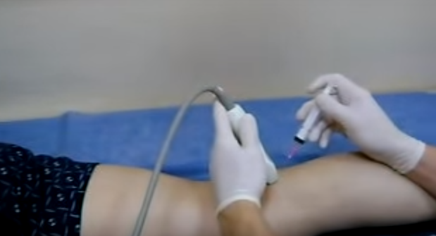 Ecografie și puncție pentru eliminarea lichidului din chistul Baker
