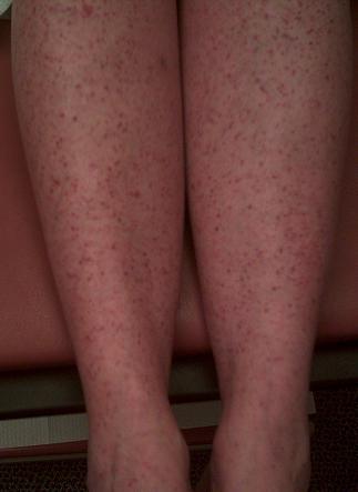 Erupții pe piele la o pacientă cu febra Q, cu infecția cu bacteria Coxiella burnetii, Foto: rxpharma.xyz