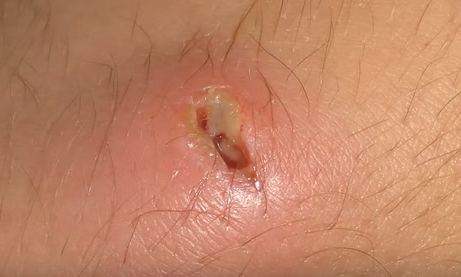 Infecții cu Stafilococul auriu
