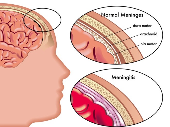 Meningita, Foto: meningitis.foundation