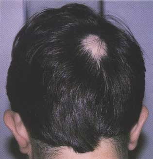 Alopecia areată, Foto: health-avenue.blogspot.com
