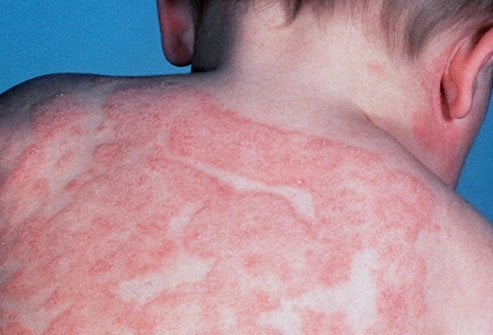 Dermatita atopică, Foto: protiv-acne.ru