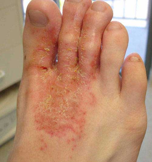 Eczema microbiană, Foto: pro-simptomy-lechenie.ru
