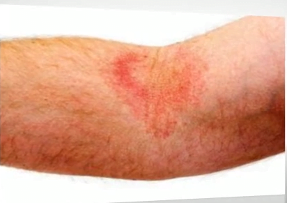 Eczema varicoasă 