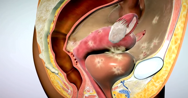 Endometrioza, inflamații