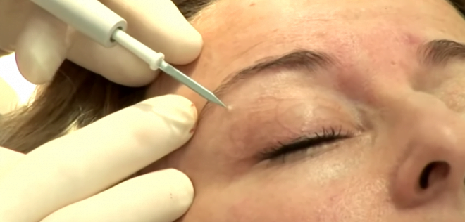 Puncție realizată de medicul dermatolog