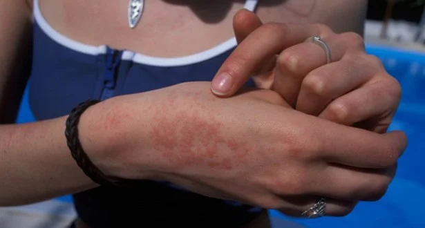 Ce boli de piele se agravează vara, în urma expunerii la soare?