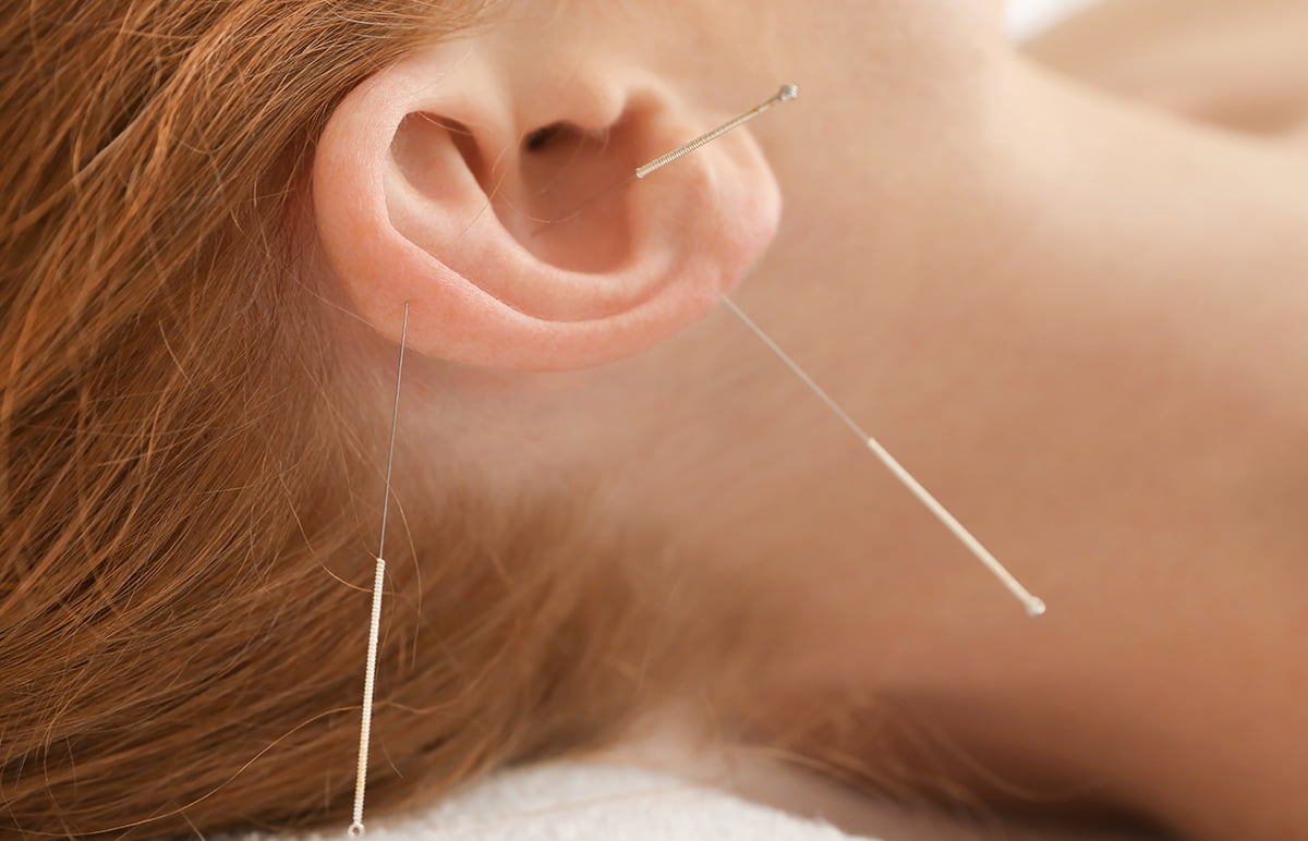 9-acupunctura