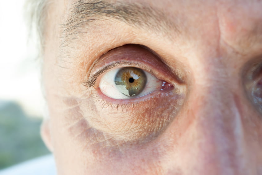 4-degenerescenta-maculara