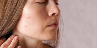 Acneea și depresia, o legătură invizibilă, dar reală – Cum să previi efectele negative?