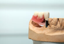 Ce înseamnă vindecare completă după un implant dentar?