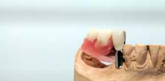 Ce înseamnă vindecare completă după un implant dentar?